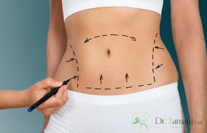 جراحی زیبایی شکم چه تاثیری می تواند بر شکم بیمار داشته باشد؟