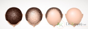 4)پیوند مو با روش IceGraft