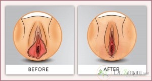 لابیا مینور طبیعی چه شکلی باید داشته باشد؟