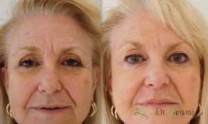 انواع مختلف ژل های تزریقی در زیبایی :