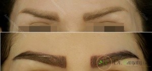 درباره کاشت ابرو