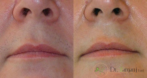 دلیل استفاده از لیزر چیست؟
