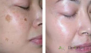 فواید لیزر پوست برای لک حاملگی چگونه است؟