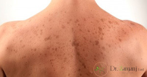 دلایل تیره شدن پوست