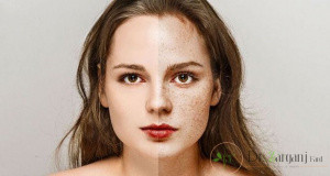 فواید لیزر پوست برای عارضه کک و مک چیست؟