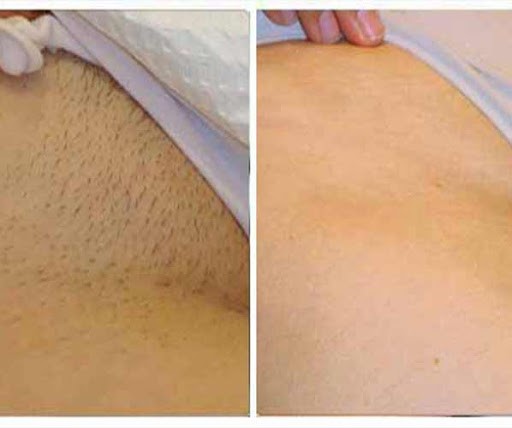 آیا انجام عمل تزریق چربی یا ژل ممکن است، منجر به کاهش میل جنسی شود؟