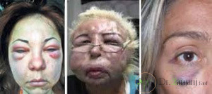 خطرات و عوارض جانبی  بوتاکس کدامند: