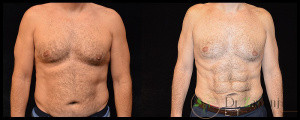 روش مینی Tummy Tuck:
