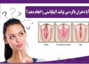 آیا عمل لابیاپلاستی برای دختر باکره خطر دارد؟