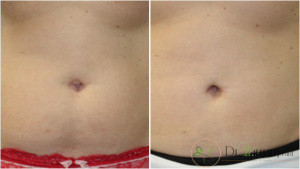 :Tummy Tuck Extendedروش