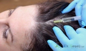 نحوه کارمزوتراپی مو چگونه است؟