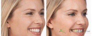 تزریق بوتاکس در چه نقاطی از بدن ممکن است؟