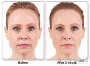 کربوکسی تراپی چگونه موجب شادابی پوست صورت می شود ؟