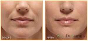 منظور از کربوکسی تراپی چیست و چه کاربردهایی دارد ؟
