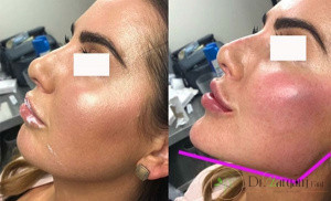 زاویه سازی صورت با چربی