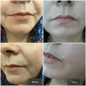 روش های رفع کردن خط خنده؟