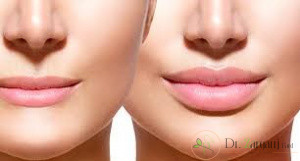 قیمت تزریق ژل در لب چقدر است؟