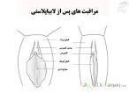 انواع عمل لابیاپلاستی به چه صورت است؟