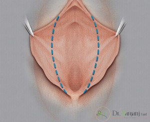 z-plasty technique