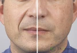 مزیت های تزریق ژل چیست؟