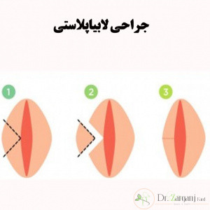 لابیاپلاستی چیست؟