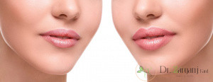 چه کسانی میتوانند از تزریق ژل استفاده کنند؟