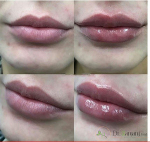 هرچند وقت یکبار باید تزریق ژل پرفکتا تکرار شود؟