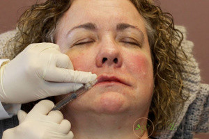 افزایش سن چه تاثیری بر حالت لب ها دارد؟