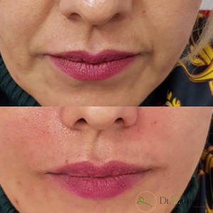 بهترین مارک ژل برای تزریق خط خنده