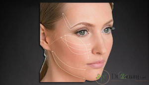 چرا عمل لیفت با نخ پیشنهاد می شود؟