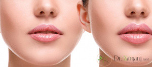 محدودیت‌ها و خطرات استفاده  از ژل لب چیست؟
