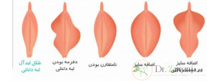 لابیا مینور چیست؟