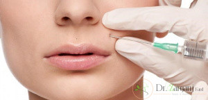 توصیه های مهم بعد از استفاده از فیلر چیست؟