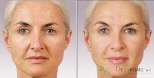 ژلهای دائمی با موقت چه تفاوتی دارند؟
