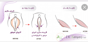 جراحی لابیا مینور