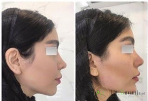 دکتر خوب برای زاویه سازی صورت
