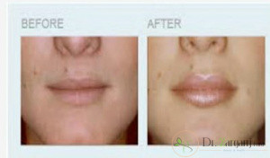 مراحل تزریق ژل لب چگونه است؟