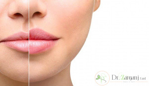 آیا تزریق ژل لب عوارض دارد؟