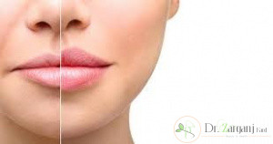 چه کسانی باید اقدام به تخلیه ژل کنند؟