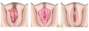 عمل لابیاپلاستی به چه کسانی پیشنهاد می شود؟