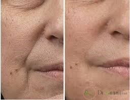 تزریق ژل چه کاربرد هایی دارد؟