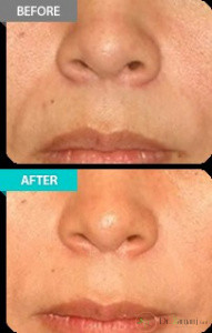 ناحیه های مورد تزریق در کجاست؟