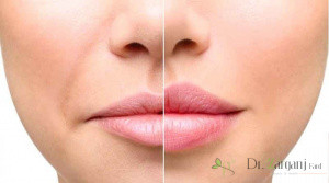 تزریق ژل کرج