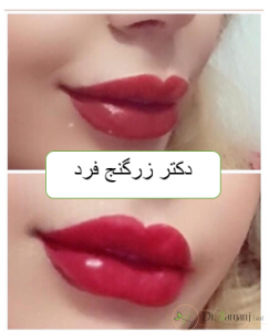 تزریق ژل لب مدل باربی
