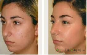 نتایج تزریق چربی به فک چطور خواهد بود؟