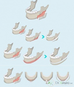 فرایند این روش به چه شکلی صورت می گیرد؟