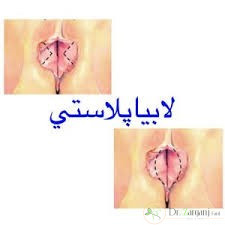 1ـ هزینه انجام دادن عمل لابیاپلاستی در قیطریه چقدر است؟