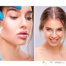 3ـ در تزریق چند نوع ژل استفاده می شود؟