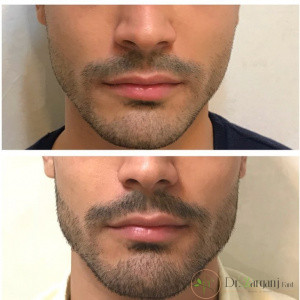 زاویه سازی فک به چه علت انجام می گیرد و منظور از زاویه سازی فک مردان چیست؟