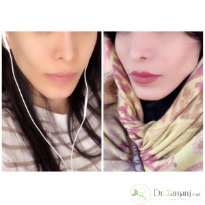 چه نکاتی در رابطه با تزریق فیلر وجود دارد؟